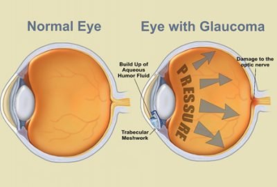 glaucoma